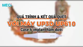 MÁY QUÉT TRONG MIỆNG UP3D UP610 - QUÉT & KẾT QUẢ CASE 6 IMPLANT HÀM DƯỚI