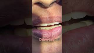 PFM CadCam MKN Dental Lab