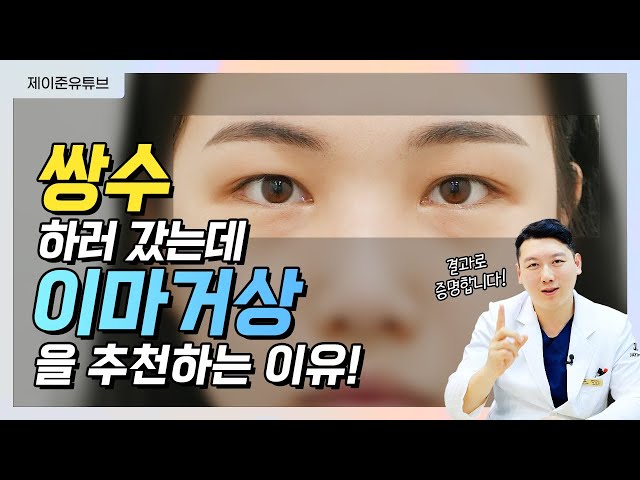 쌍꺼풀 하러 갔다가 이마거상까지? 꼭 봐야 하는 이유!