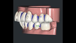 Simplyceph 3DS blocking out gaps between teeth for the printing models