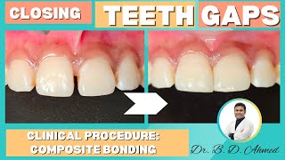 Closing Front Teeth Gaps Composite Bonding How Its Done