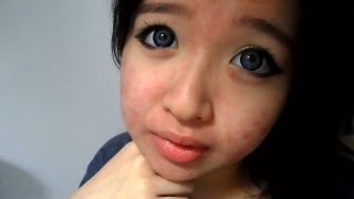 My Acne Story 12Th Week Of Accutane