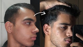 How I Reversed My Receding Hair Line In 8 months