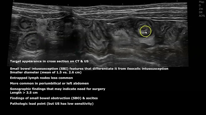 Small Bowel Intussusception