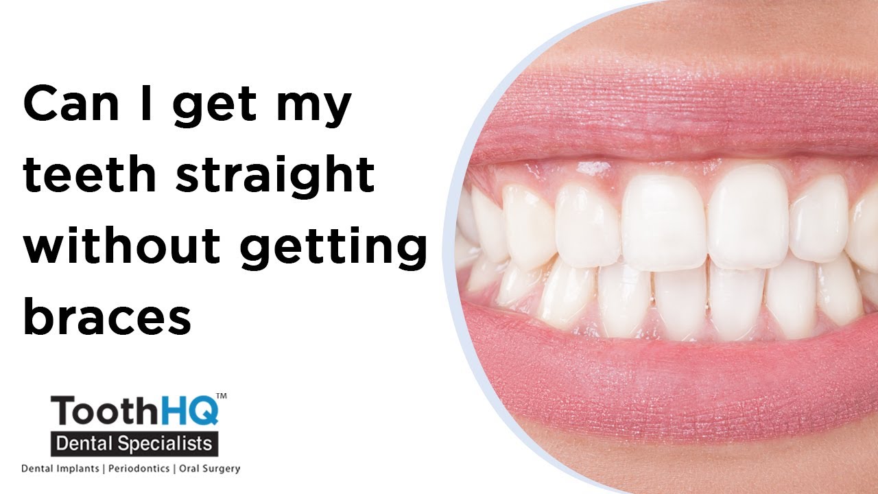 Can I get my teeth straight without getting braces_ Carrollton ToothHQ