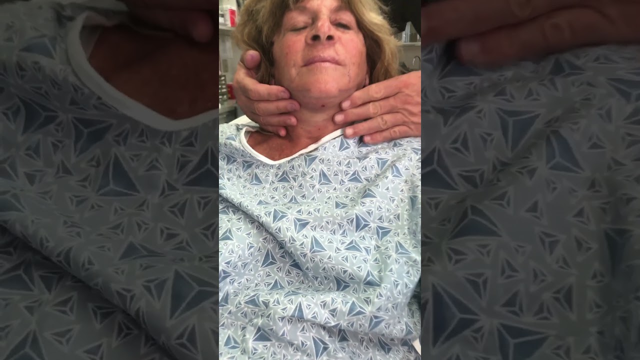 Face Lift Results! Immediate! Dr. Thomas Barnes Newport Beach Cosmetic Surgeon MUST SEE!