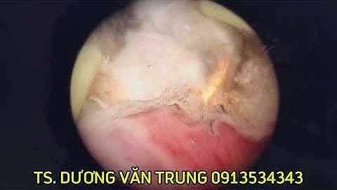 CẮT U TUYẾN TIỀN LIỆT NỘI SOI- ÔNG ĐƯỜNG- TS.BS DƯƠNG VĂN TRUNG 0913534343