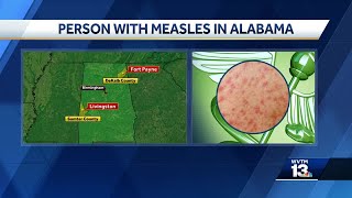 Some Alabama residents likely exposed to measles
