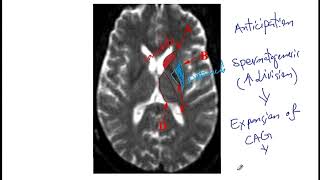 USMLE ACE Video 31: Huntington’s Disease