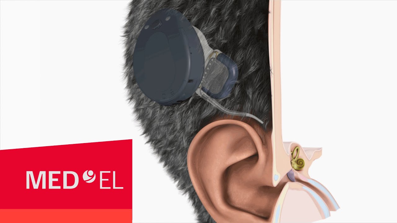 The MAESTRO Cochlear Implant System from MED-EL with RONDO | USA
