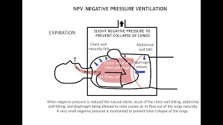 Negative Pressure Ventilation - exovent