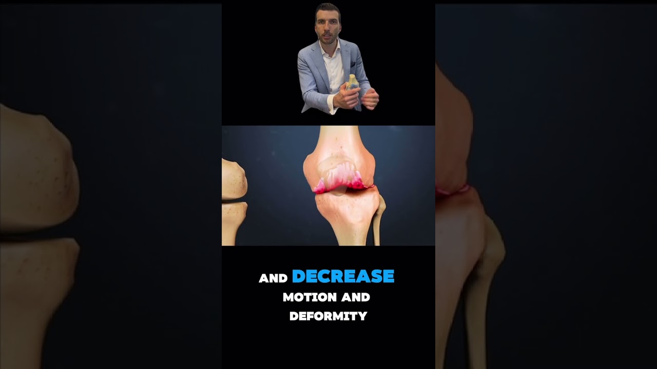 MIRA™️ Robotic Surgery for Knee Arthritis | Dallas–DFW Orthopedics