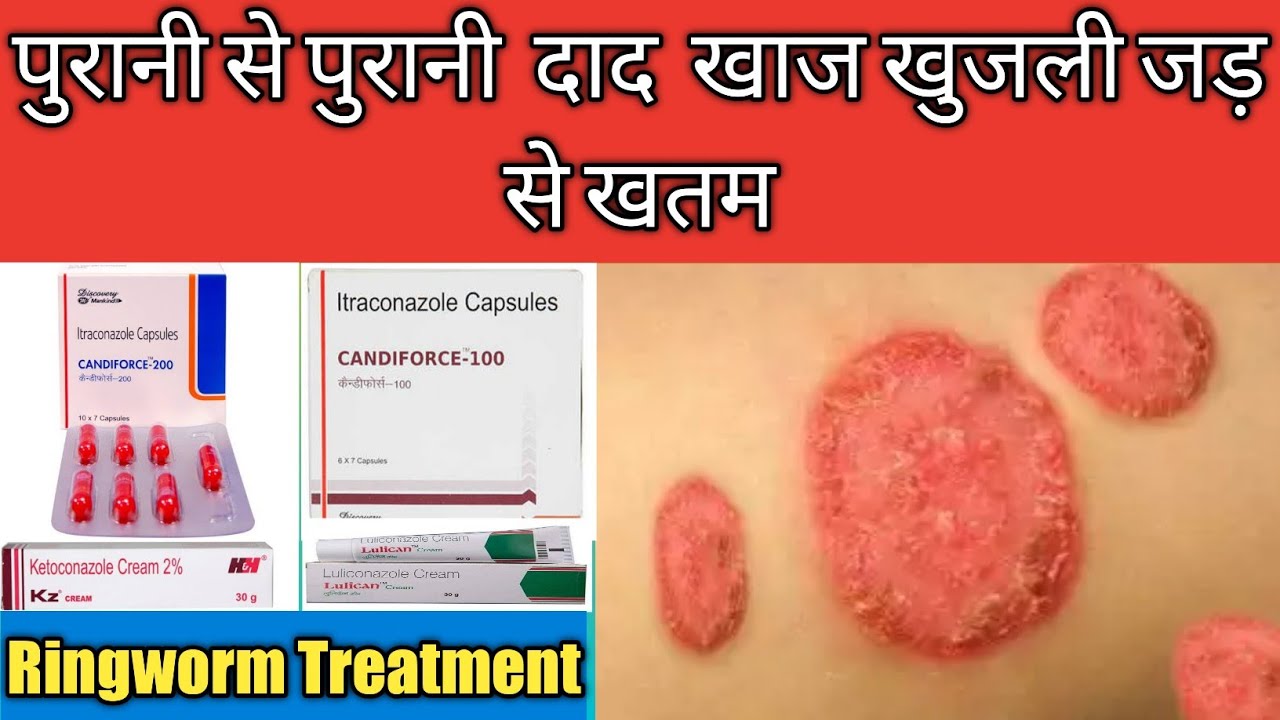 दाद , खाज,खुजली का जड़ से सम्पूर्ण ईलाज Dad Khaj Khujli Treatment
