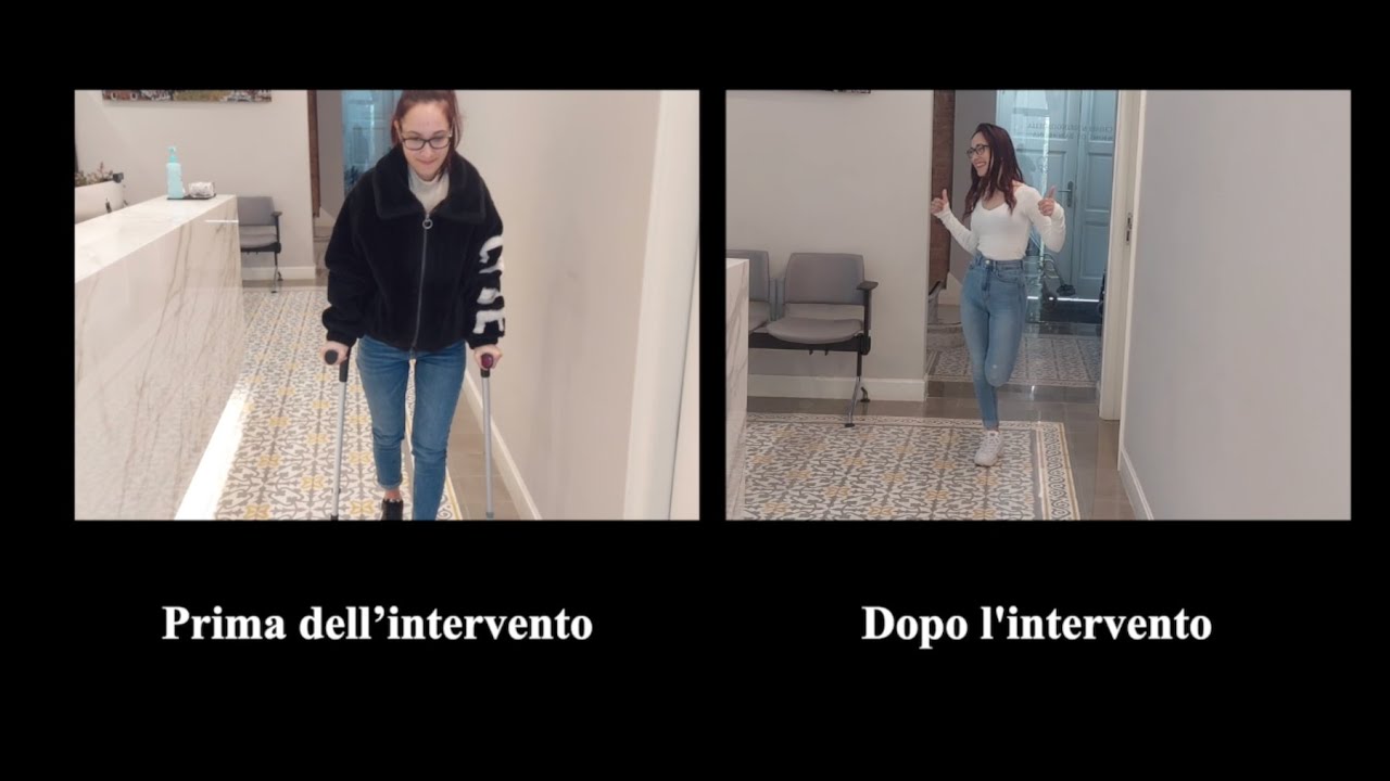 SNCV, Malattia del filum, Sindrome d’Arnold Chiari I, siringomielia idiopática, scoliosi idiopática.