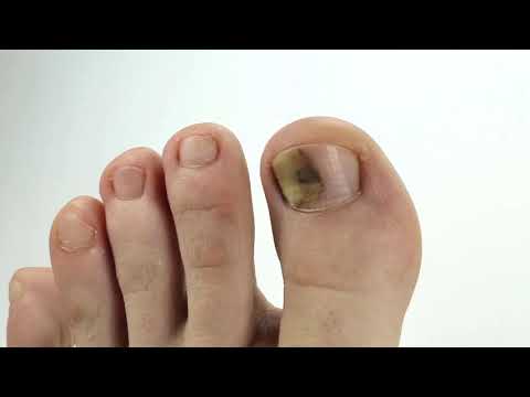 Što uzrokuje grčeve u stopalima?