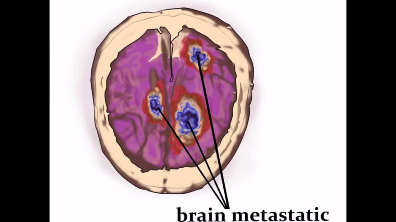 Меланома в легких. Метастазы в головном мозге. Метастазированием в головной мозг. Метастатические опухоли головного мозга.
