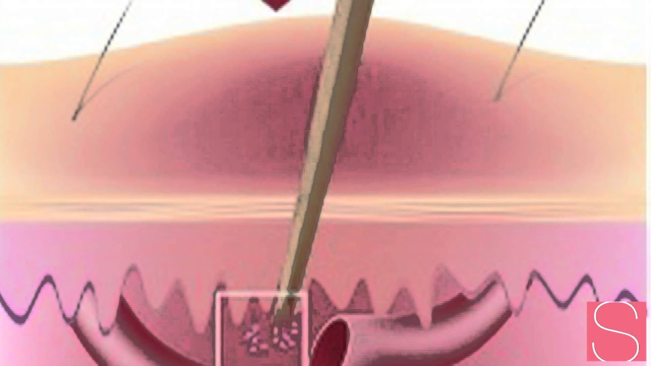 Sugaring Vellus Hair YouTube