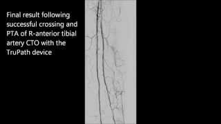 TruePath Anterior Tibial CTO
