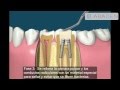 Endodoncia - Tratamiento para matar el nervio del diente - Abaden Dentistas