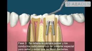 Endodoncia  Tratamiento para matar el nervio del diente  Abaden Dentistas