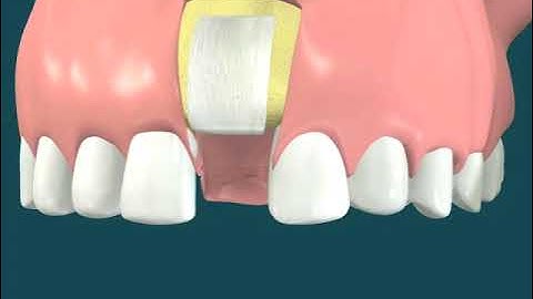 Dental Video for  Tooth Grafting with Titanium Membrane - The Tooth