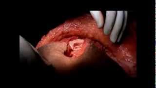 Skin Sparing Mastectomy- TRAM Breast Reconstruction- Dr Rajnish Talwar- Electrosurgery Video