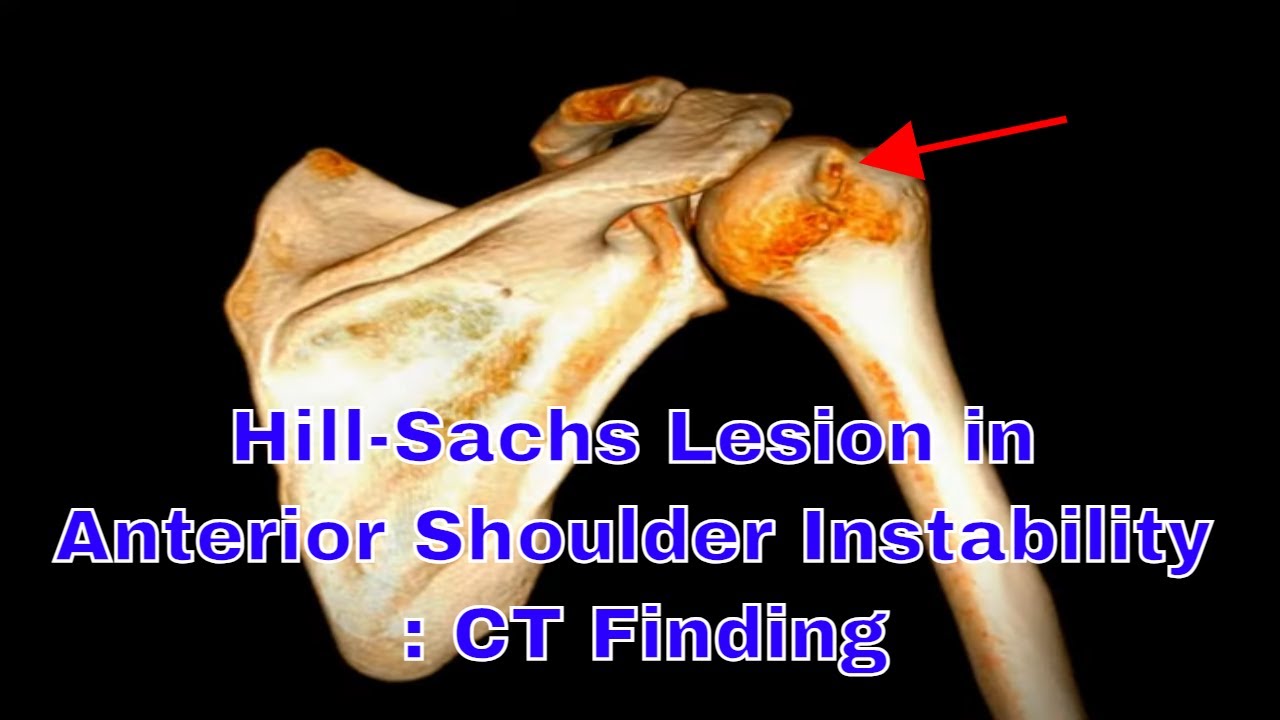 Hill Sachs Lesion In Anterior Shoulder Instability CT Finding YouTube Hill Sachs Lesion In Anterior Shoulder Instability CT Finding YouTube