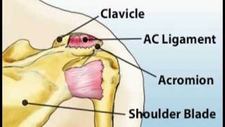 Understanding Shoulder Pain (Sports Injuries #3)