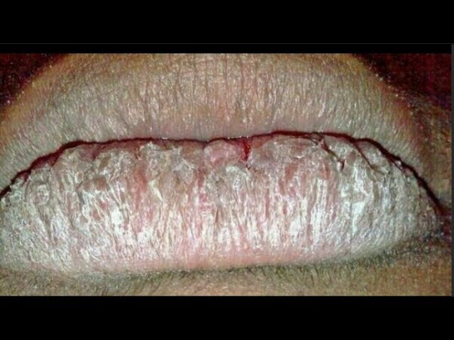 The Most CHAPPED LIPS On Earth - YouTube The Most CHAPPED LIPS On Earth - YouTube
