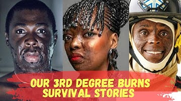 Our 3rd Degree Burns Survival Stories (Zoom Video) Part 1