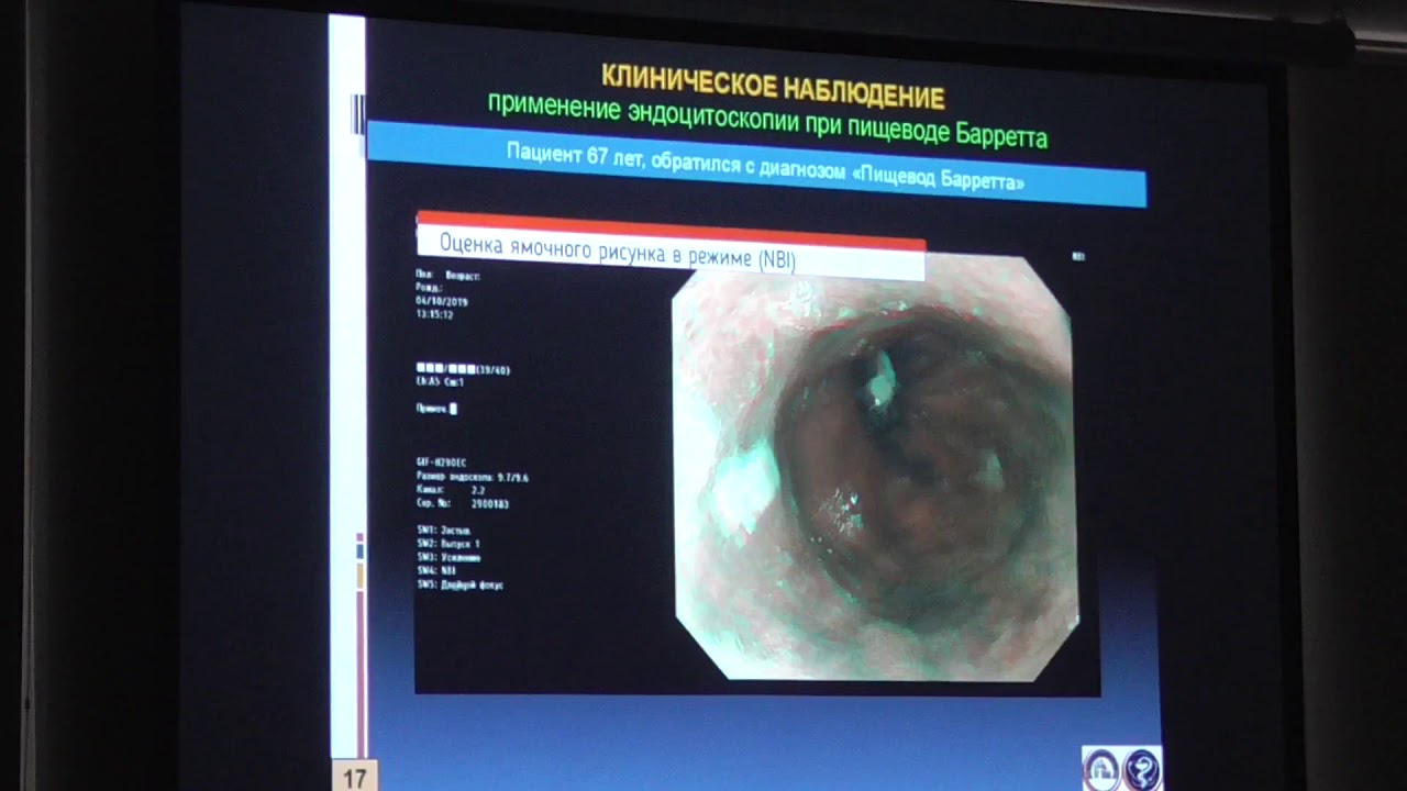 Цилиндроклеточная метаплазия пищевода. Пищевод Барретта диспансерное наблюдение. NBI эндоскопия пищевода Барретта. Пищевод Барретта метаплазия. Пищевод Барретта клиника.