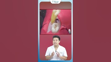Nhổ Răng Khôn Có Đau Không | Nha Khoa Minh Châu