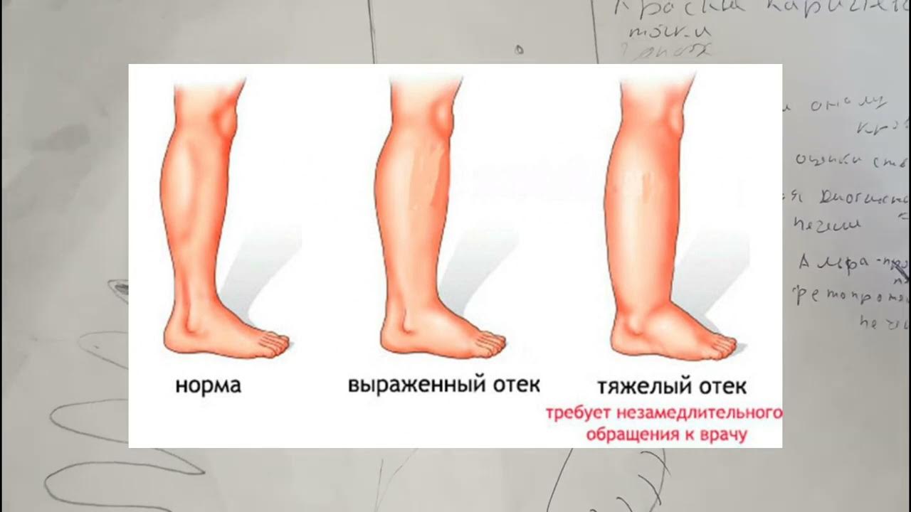 Как очень быстро снять отеки фиброз цирроз жировой гепатоз печени определяет по ступням ног и какие анализы н