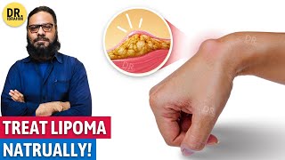 Lipoma Ka Qudrati Ilaj | Natural Remedies for Lipoma | Urdu/Hindi | Dr. Ibrahim screenshot 3