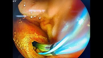 NỘI SOI MẬT TỤY NGƯỢC DÒNG (ERCP): GIẢI PHÁP VÀNG TRONG ĐIỀU TRỊ SỎI ỐNG MẬT CHỦ