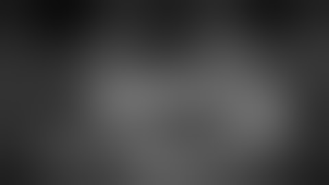 Graftless sinus augmentation with 3 D ridge augmentation