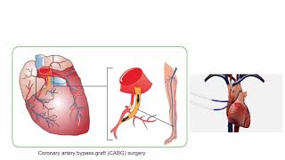 Coronary heart disease and anorexia nervosa