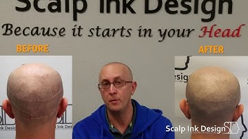Hide Hair Transplant Scars with Scalp Micropigmentation - Darrian