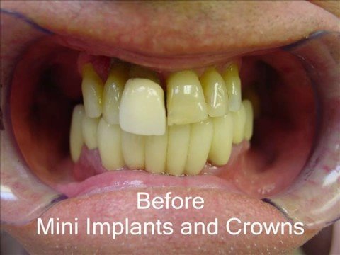 Newest Dental Implants To Be Used