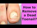 How to Remove a Dead Toenail ??? Simple sculptured acrylic nail\\ГНИЛОЙ НОГОТЬ ПЕДИКЮР