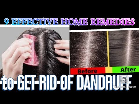 9-effective-home-remedies-to-get-rid-of-dandruff-naturally