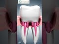 Root canal treatment #rootcanaltreatment, #rootcanal, #endodontics