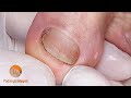 Thorough toenail trimming and cleaning of the nail bed | Podological treatment of nail psoriasis