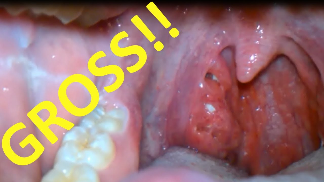 tonsillectomia fogyás felnőttek
