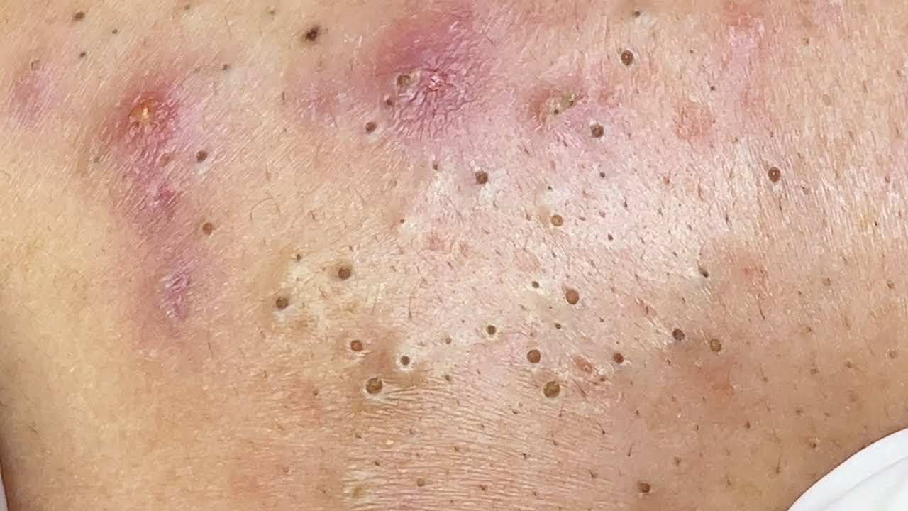 Blackheads & Milia, Big Cystic Acne Blackheads Extraction Whiteheads Removal Pimple Popping 00