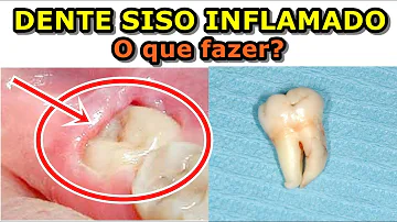 O que fazer quando o siso está inflamado?