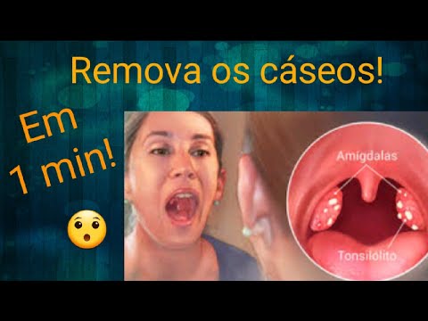 Como remover CÁSEOS ou BOLINHAS FEDORENTAS da garganta em 1 MIN !