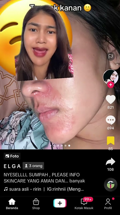 Efek samping krim steroid! Cara Mengobati Dermatitis Perioral #skincare #drshinta #jerawat