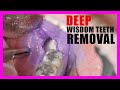 Wisdom teeth removal  tooth sectioning procedure surgical guide  online courses