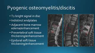 Extradural spinal infection